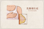 乳腺增生症