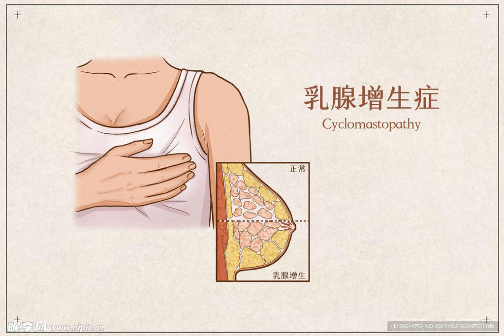 乳腺增生症