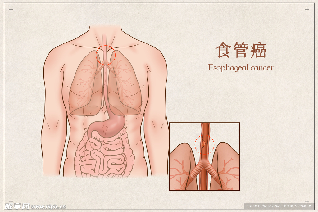 食管癌