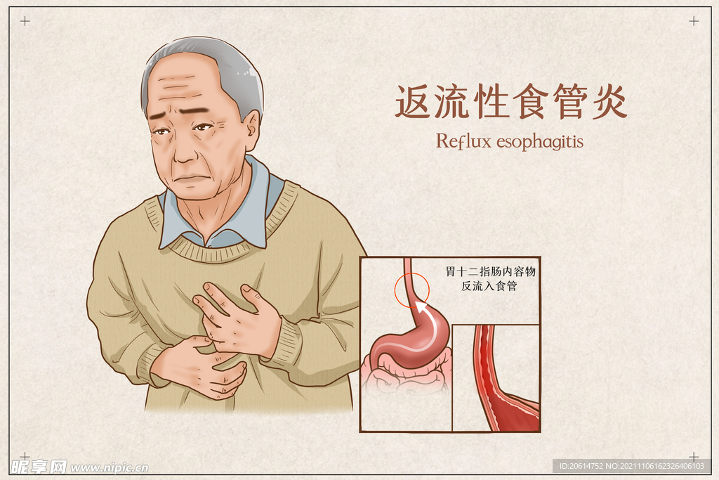 反流性食管炎