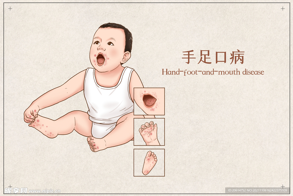 手足口病