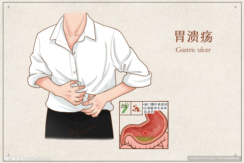 胃溃疡