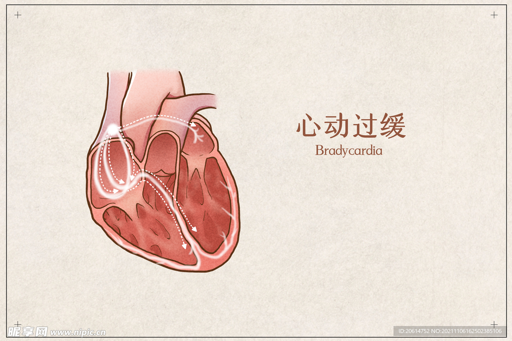 心动过缓