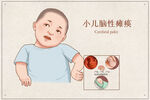 小儿脑性瘫痪