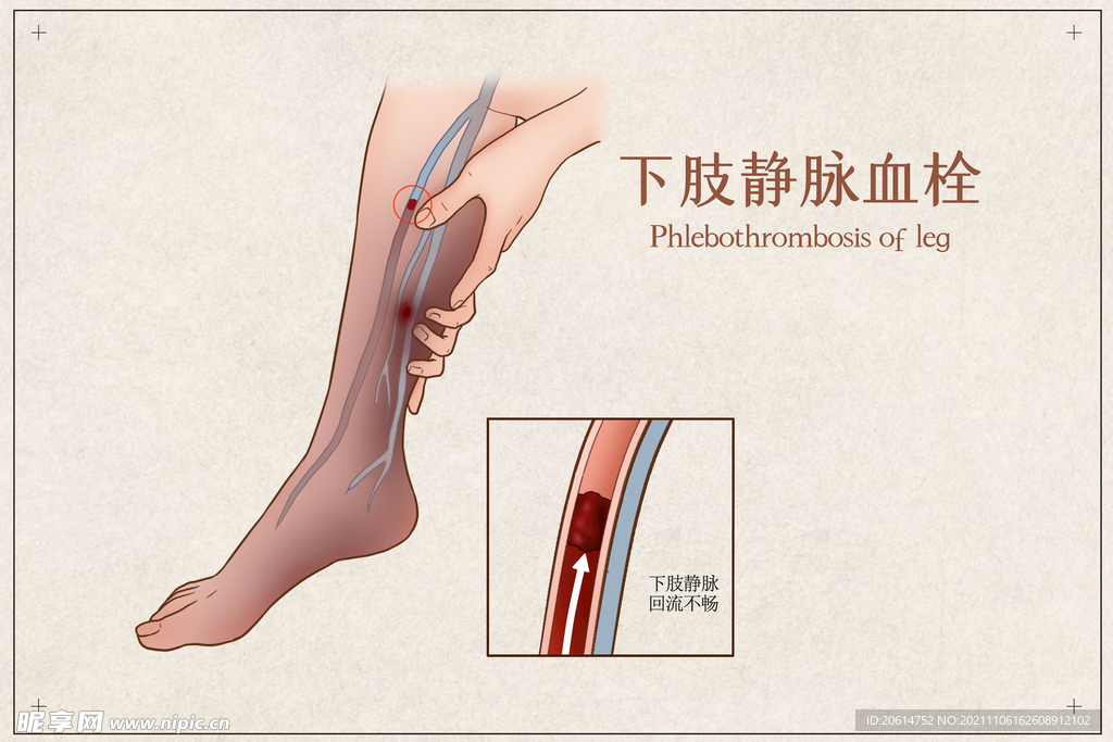 下肢静脉血栓