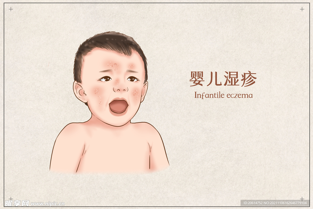 婴儿湿疹