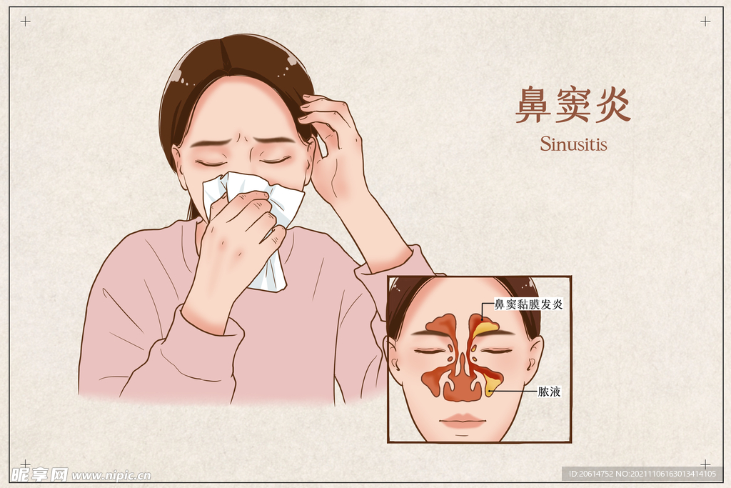 鼻窦炎