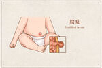 脐疝