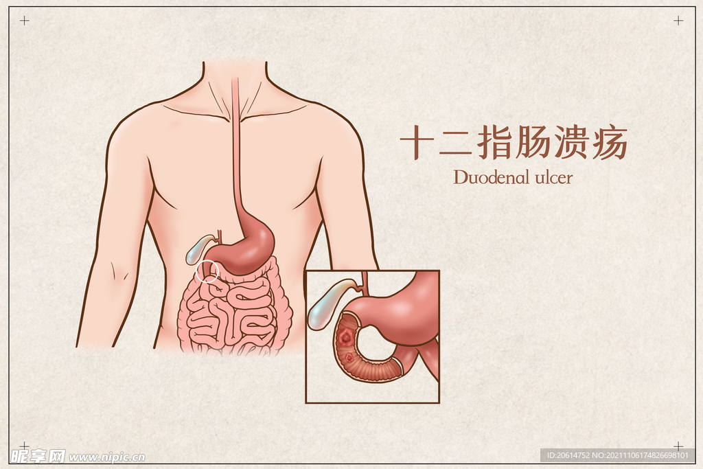 十二指肠溃疡