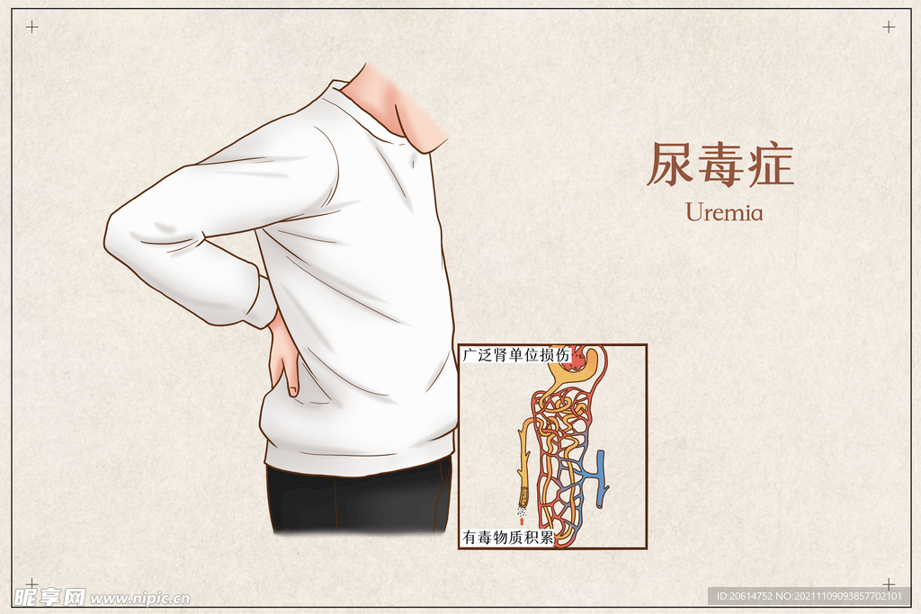 尿毒症