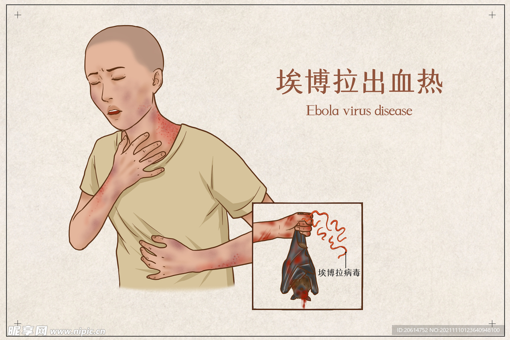 埃博拉出血热