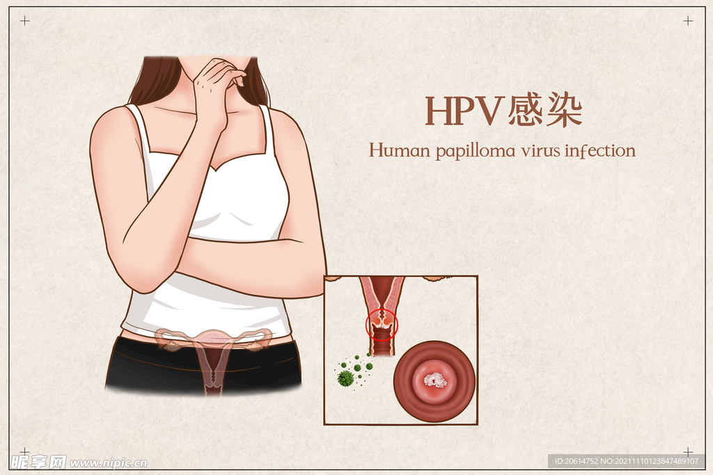 HPV感染
