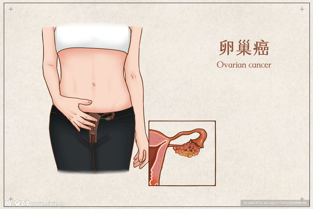 卵巢癌
