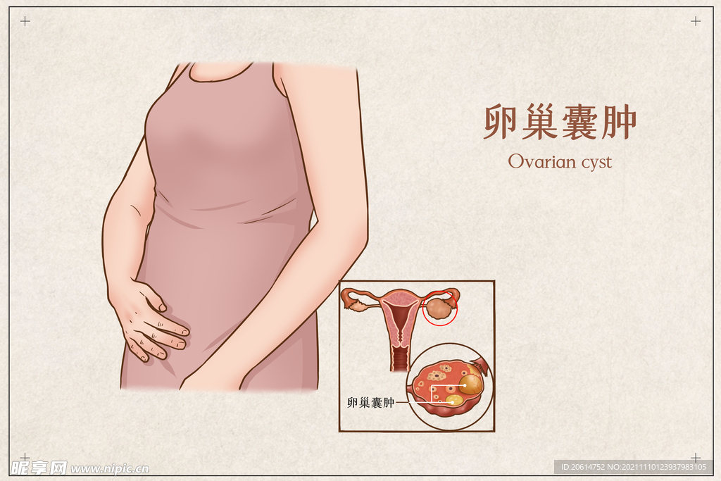 卵巢囊肿