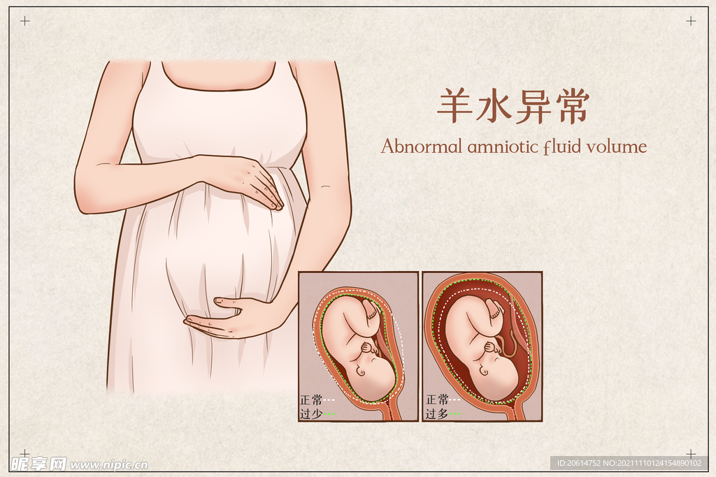 羊水异常