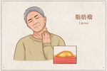 脂肪瘤