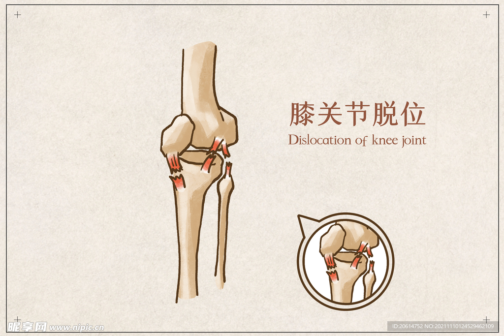 膝关节脱臼