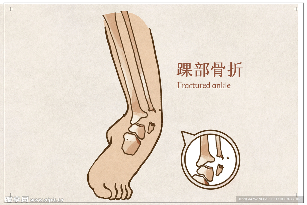 裸部骨折