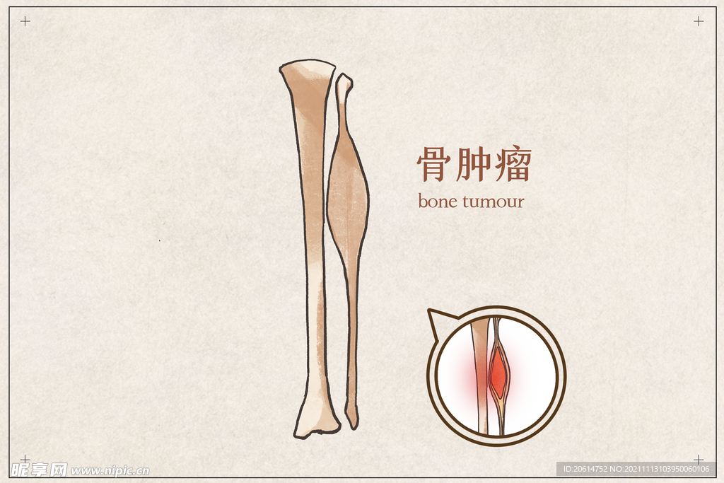 骨肿瘤