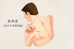 肩周炎
