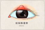 睑板腺囊肿