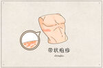 带状疱疹