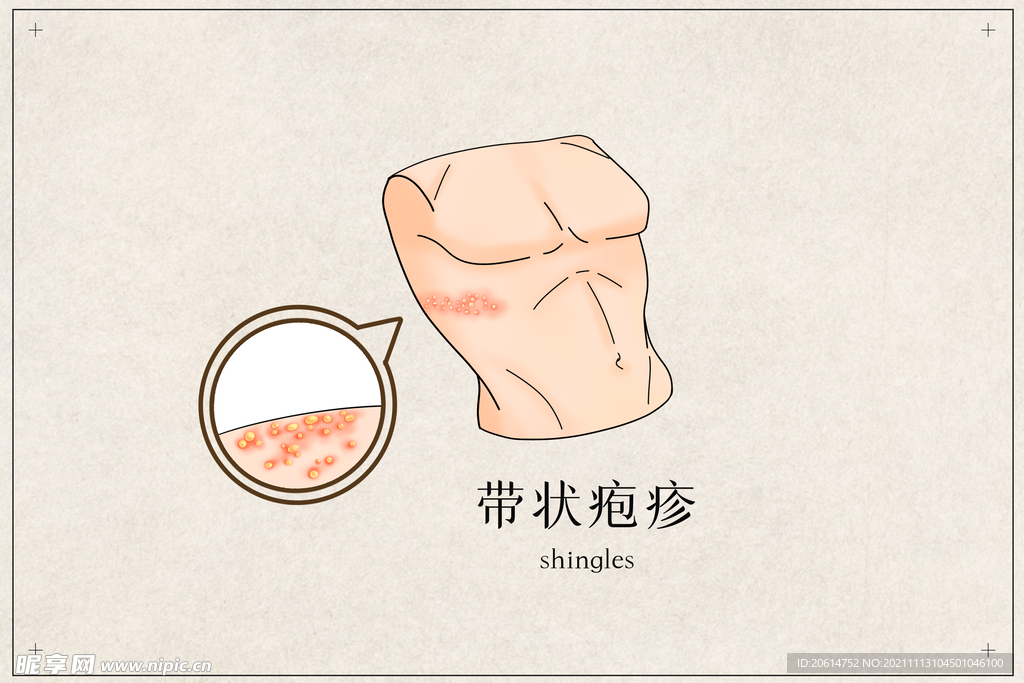 带状疱疹
