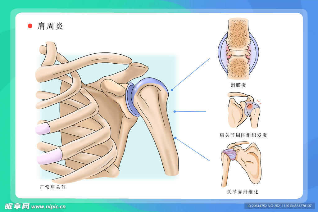 肩周炎