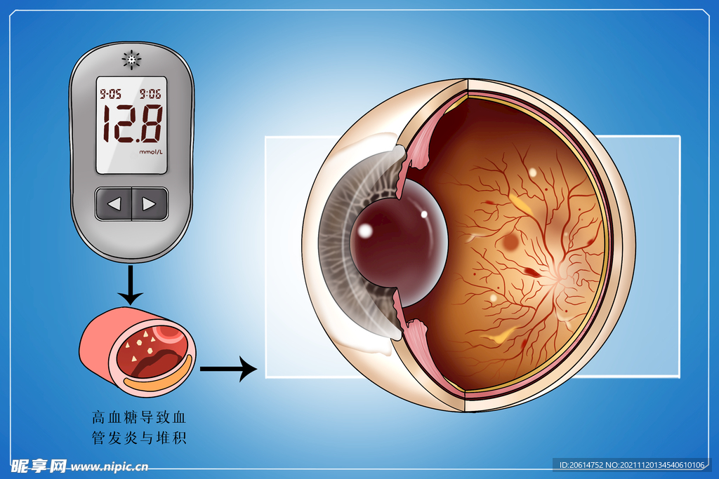 糖尿病并发症