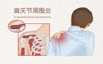 肩周炎