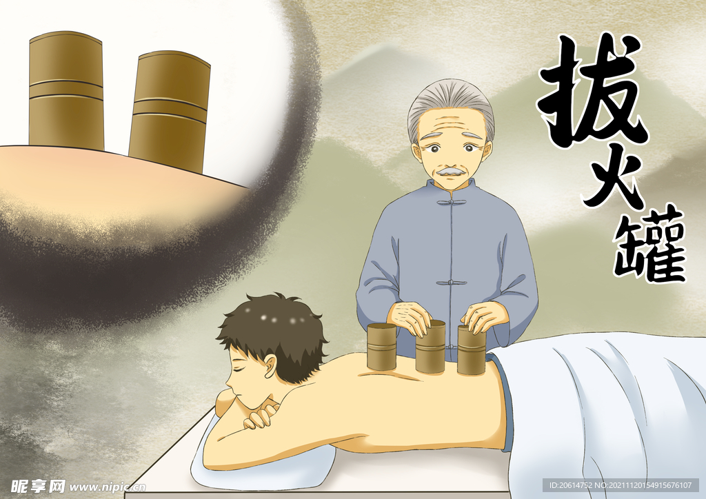 拔火罐