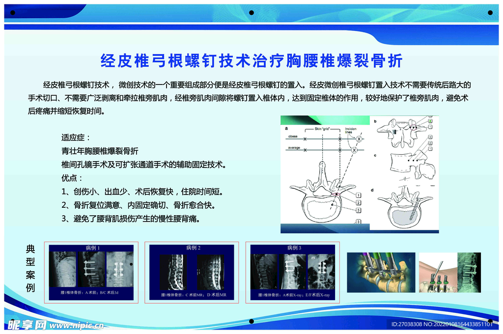 经皮椎弓根螺钉治疗腰胸椎骨折