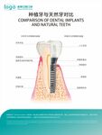 口腔种植牙于天然牙对比