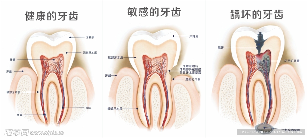 牙齿健康损坏展示图