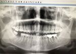 缺失牙根管治疗智齿拔除金属牙冠