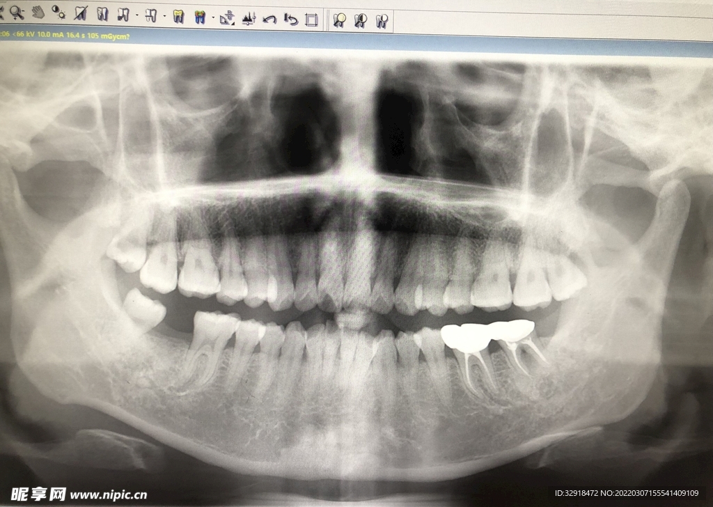 缺失牙根管治疗智齿拔除金属牙冠