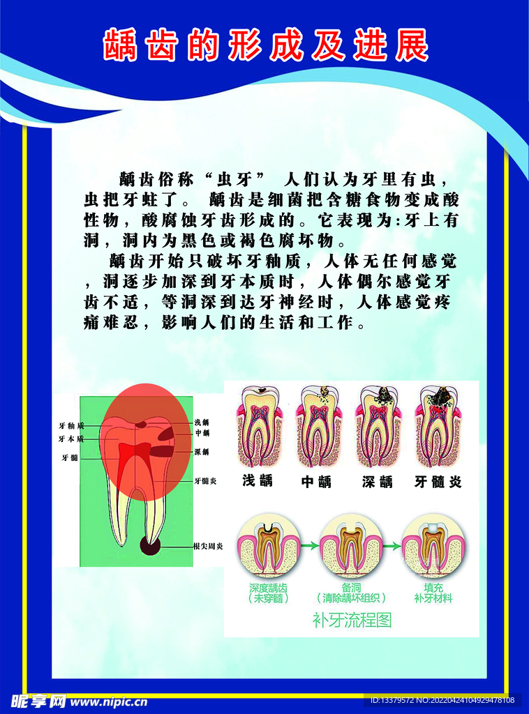 口腔 牙齿 龋齿形成