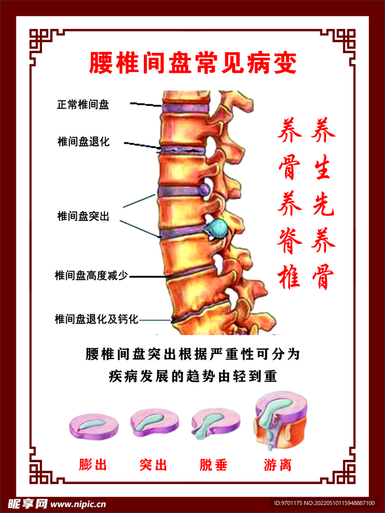 腰间盘突出