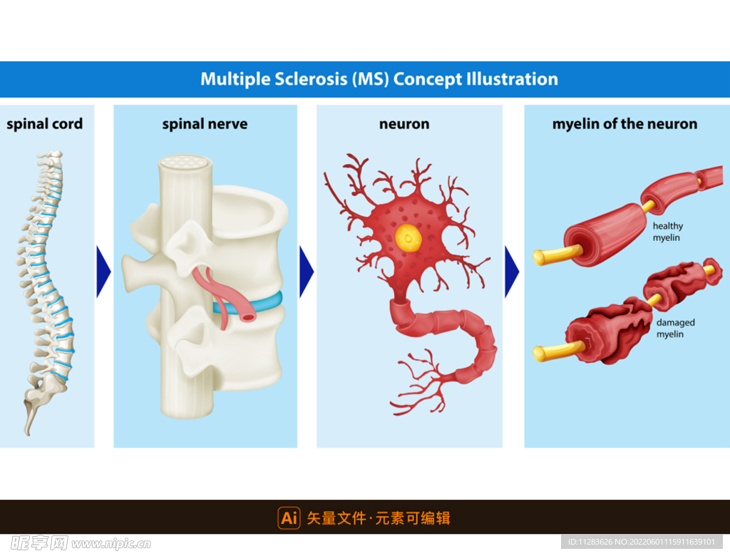 医学多发性硬化插画