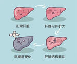 肝硬化