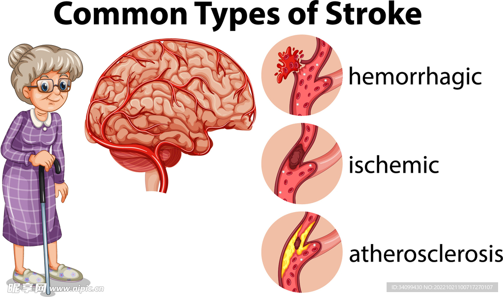 脑卒中