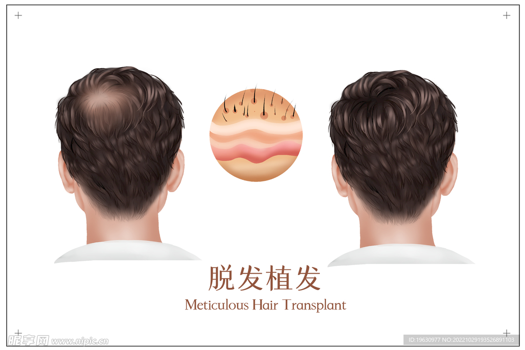 男性脱发植发医疗