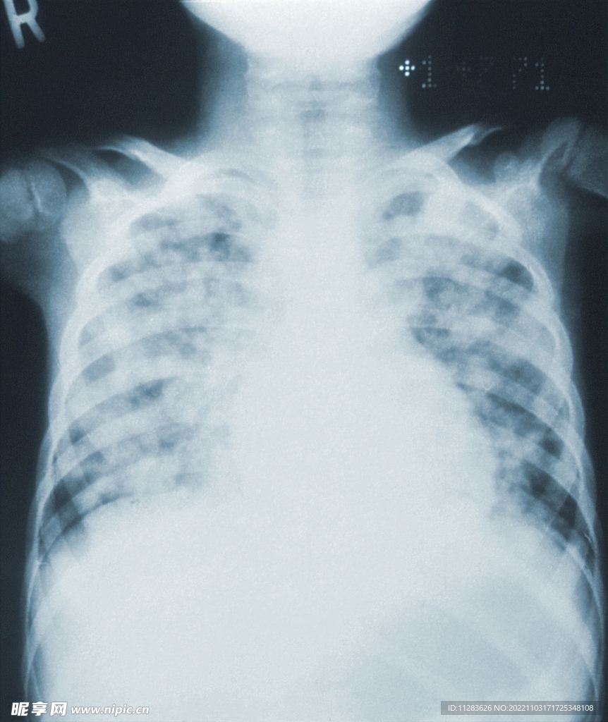 肺部X光片影像