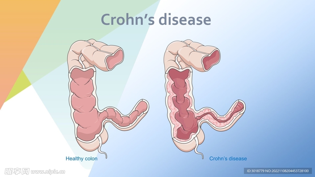 克罗恩病