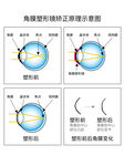 角膜塑形镜矫正原理示意图