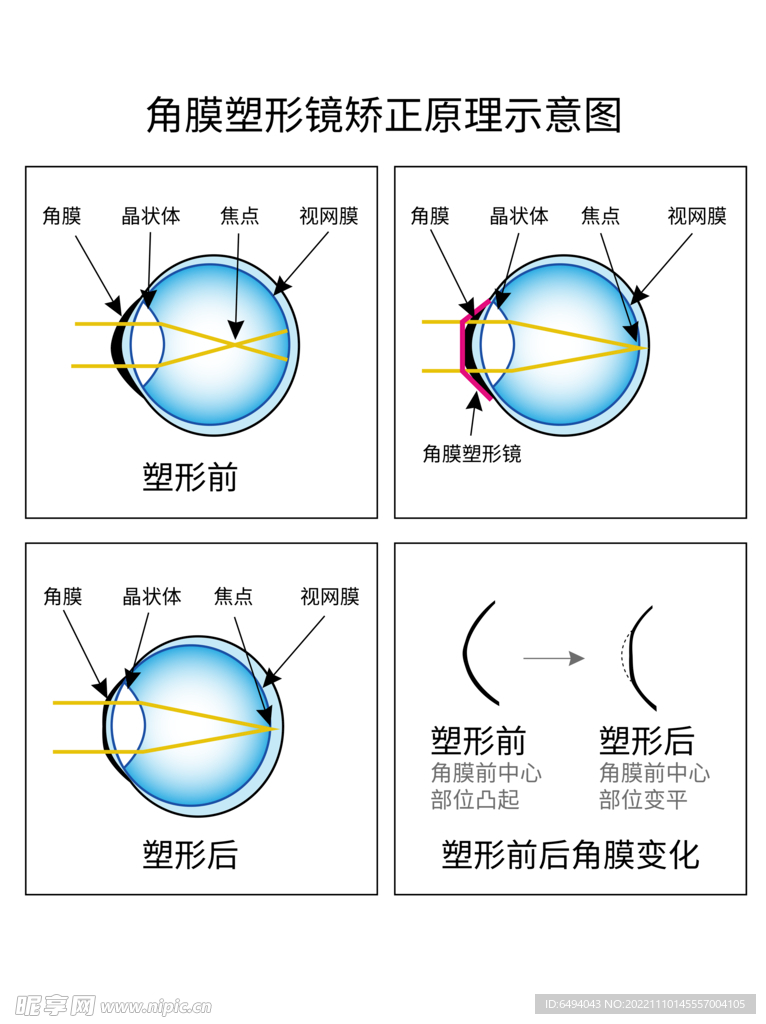 角膜塑形镜矫正原理示意图