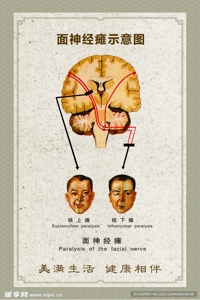 面神经瘫示意图