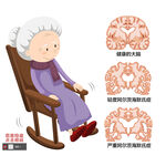 阿尔茨海默氏症卡通