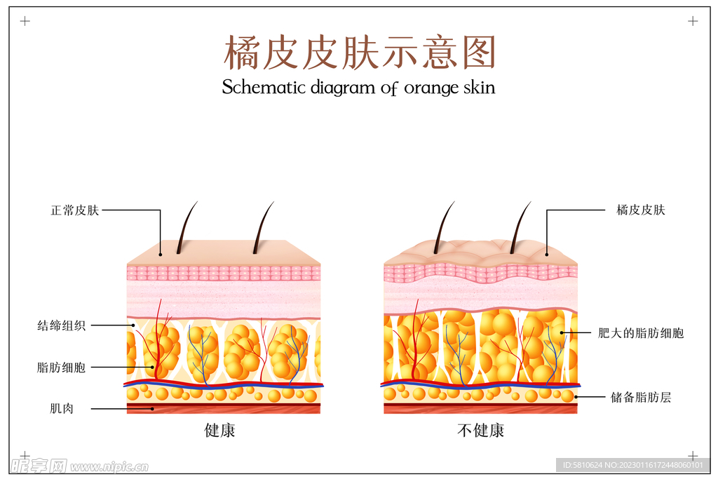 橘皮皮肤示意图