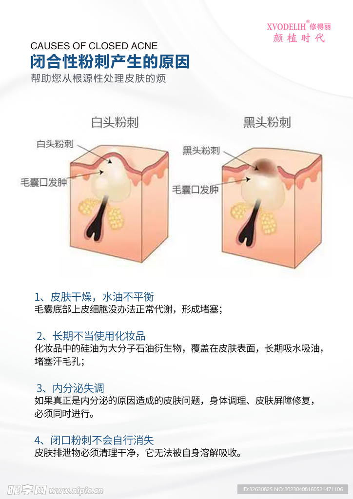 白头黑头粉刺形成原因